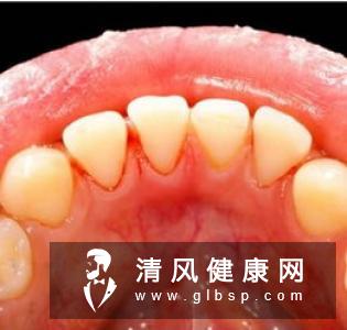 牙龈经常出血是什么原因呢