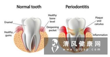 消退素与牙周病关系的研究进展