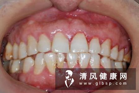 哪些病会导致牙龈出血？