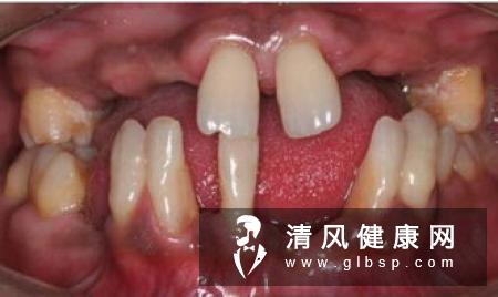 牙周病:最常见但最容易被“混淆”的口腔疾病