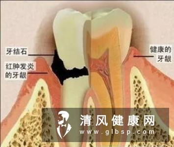 牙龈炎的早期症状有哪些